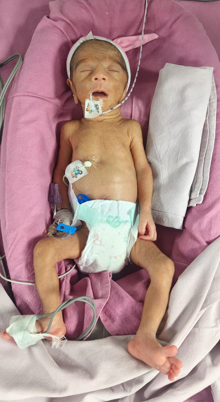 Help Save Baby of Kiran