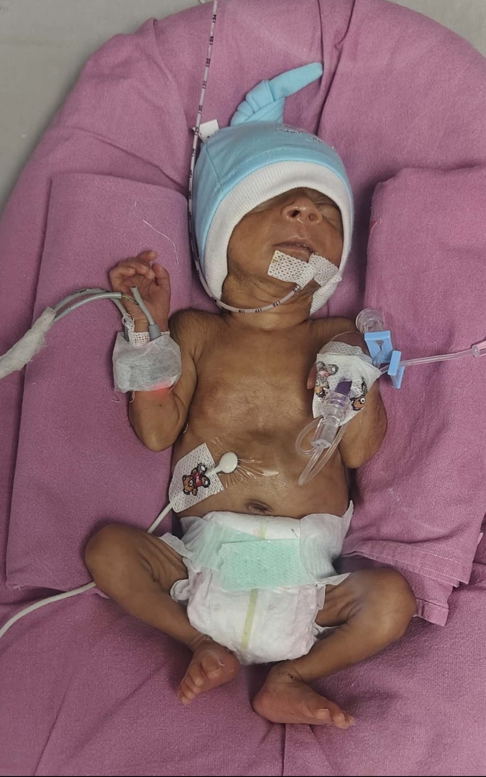 A Breath of Hope: Help Komal’s Baby Fight for Life