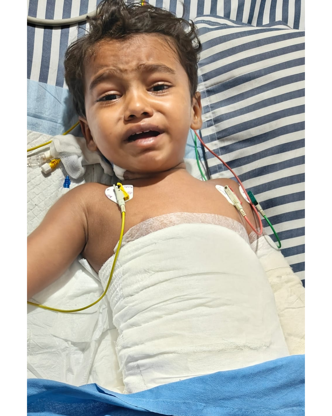 Help Save Little Master Saurabh – A 3-Year-Old Fighting Severe Burn Injuries