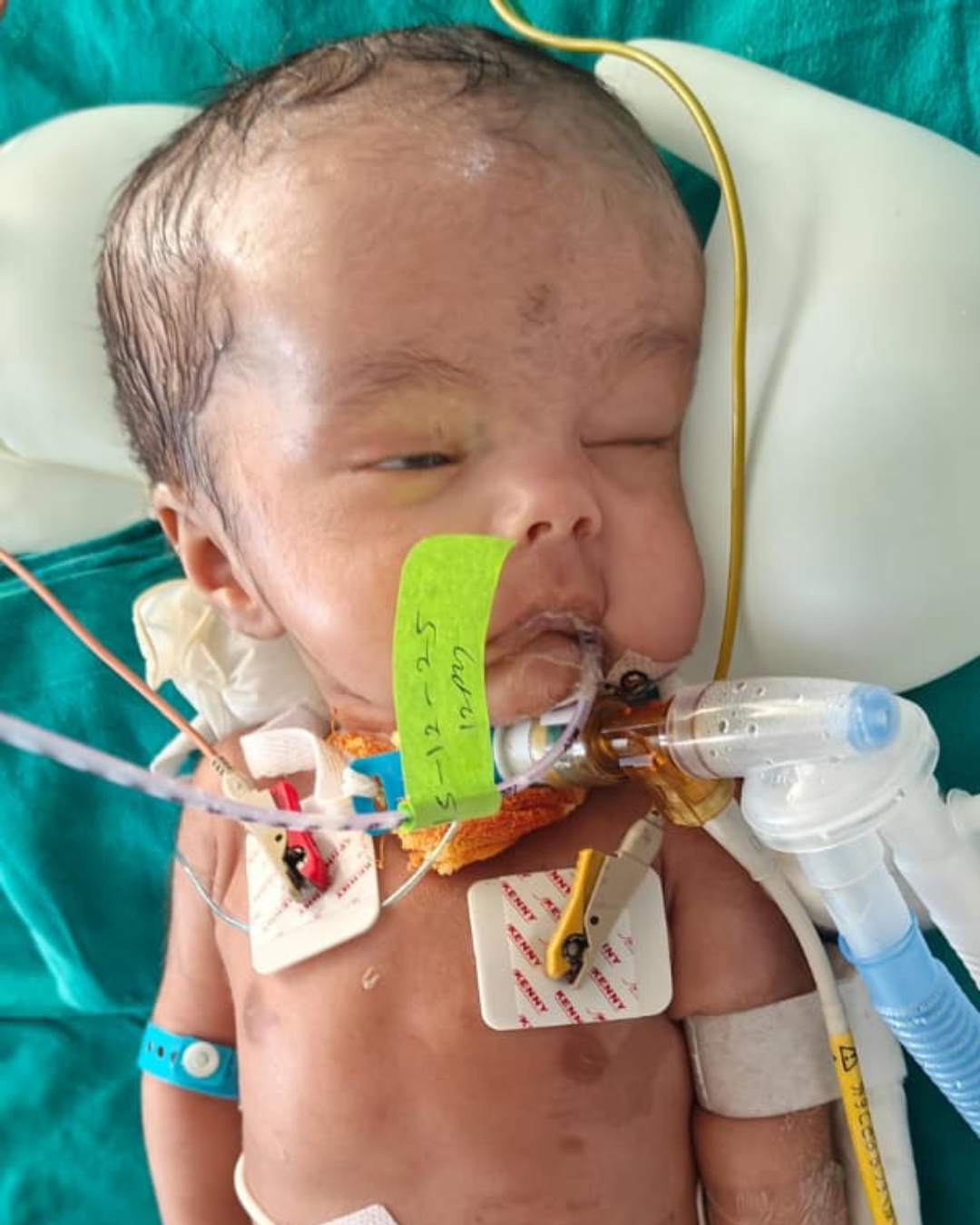 Help Save Baby Himanshu’s Life