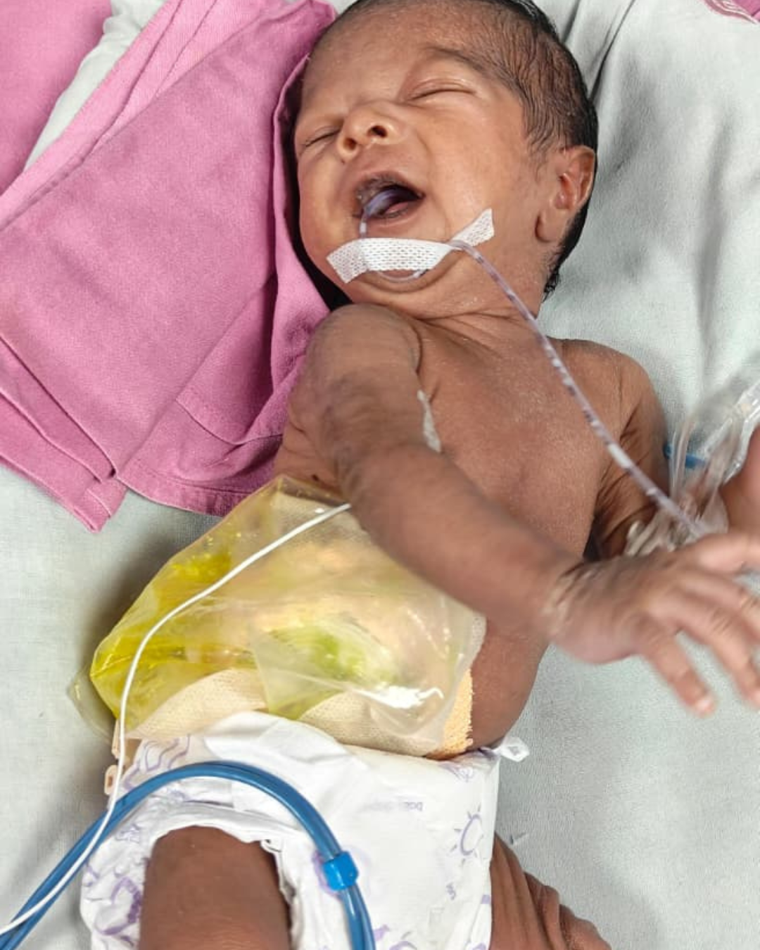 A Newborn’s Fight for Life Save Baby of Jyoti