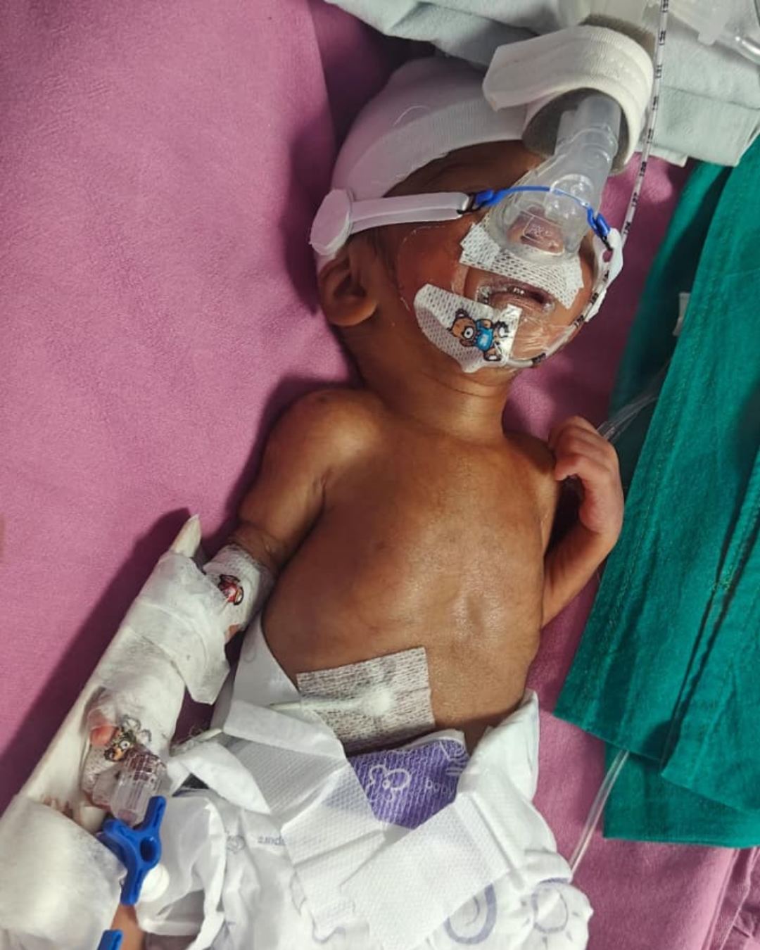 Save Baby of Punam A Fragile Life Fighting to Survive