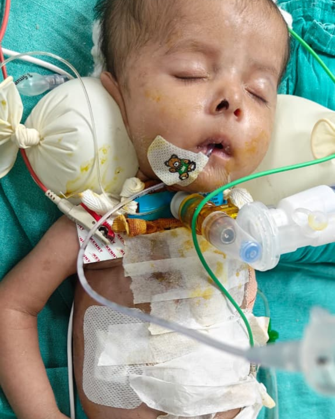 Save Baby Shreesha A Tiny Heart Fighting for Life