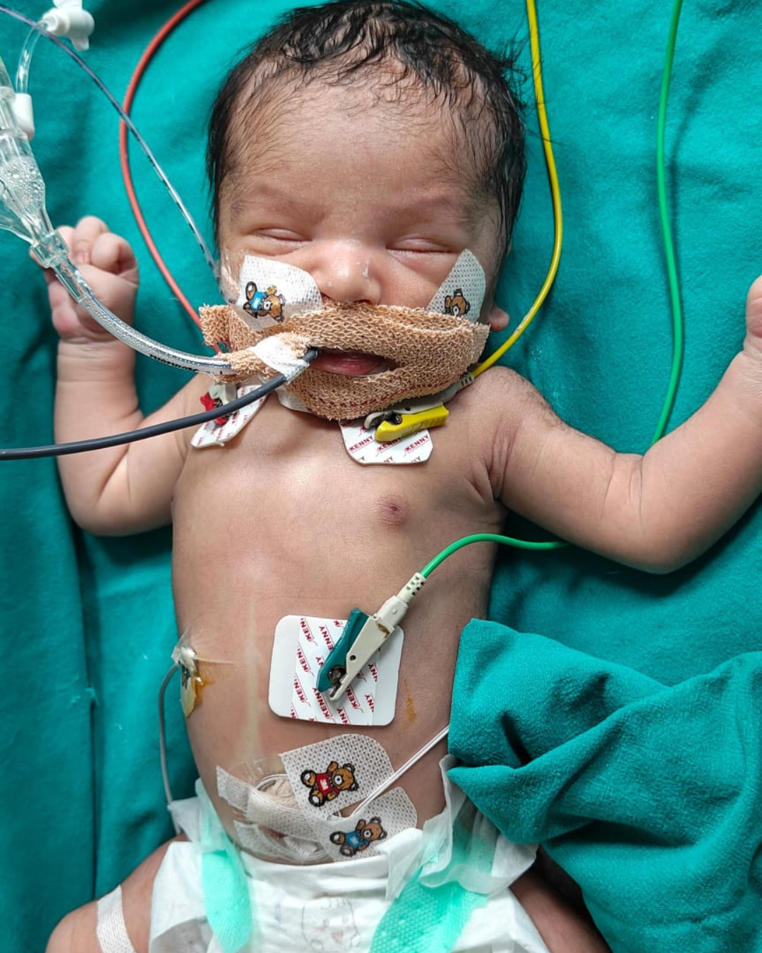 Save Baby of Pooja — A 1-Day-Old Child