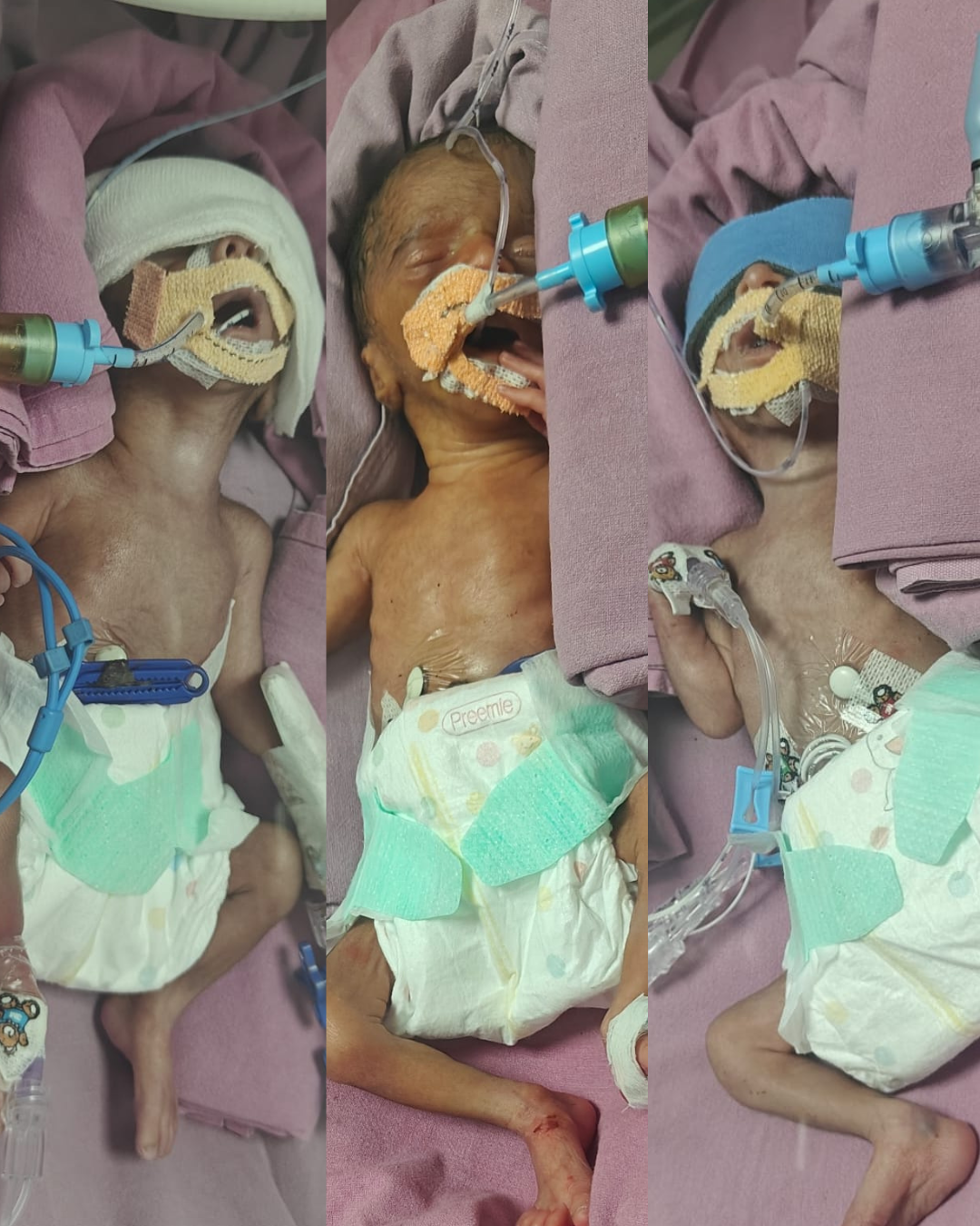 Triplets baby of Vijaylaxmi