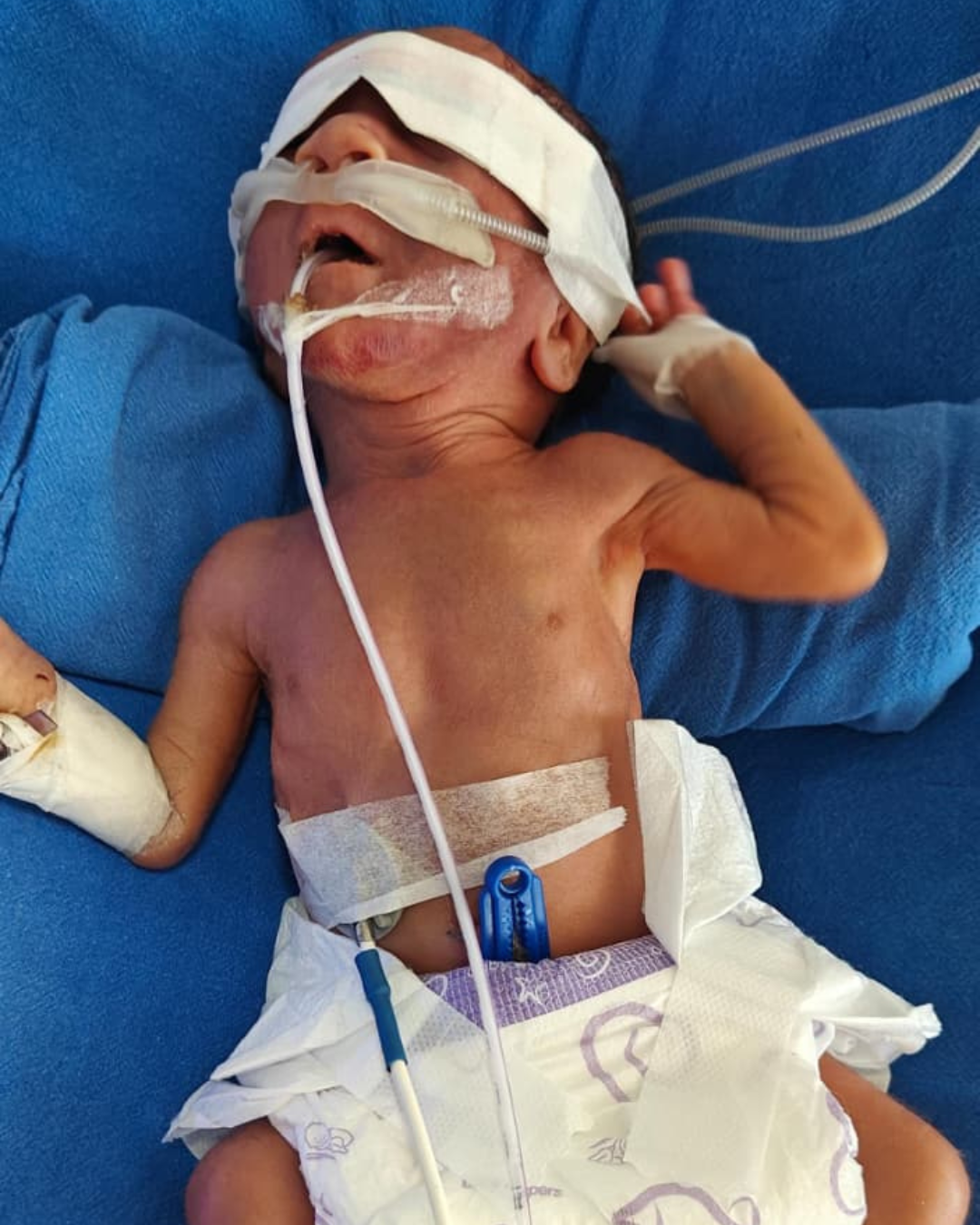 Baby of Seema, Need urgent help.