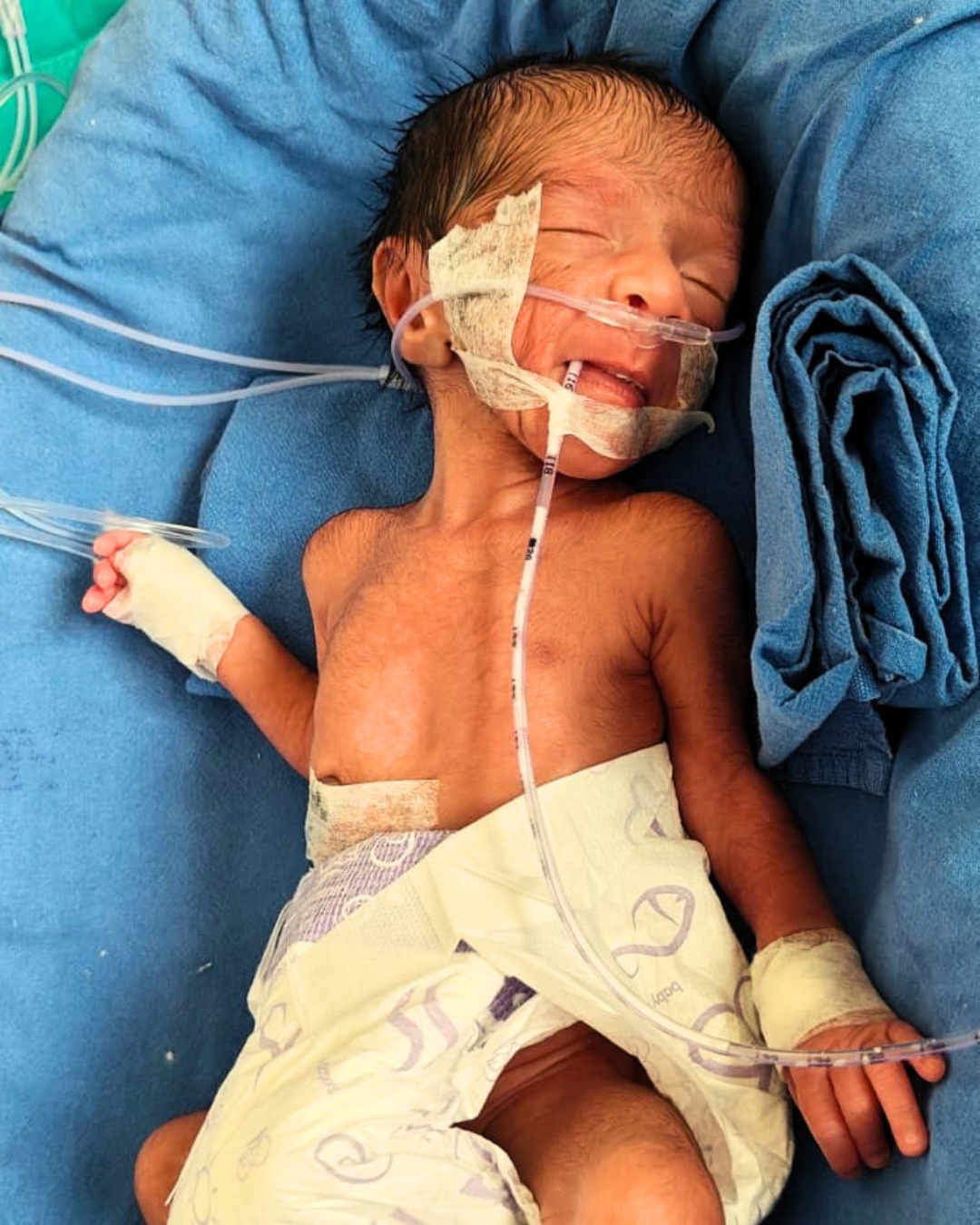 Baby of Santra, Twin 1st