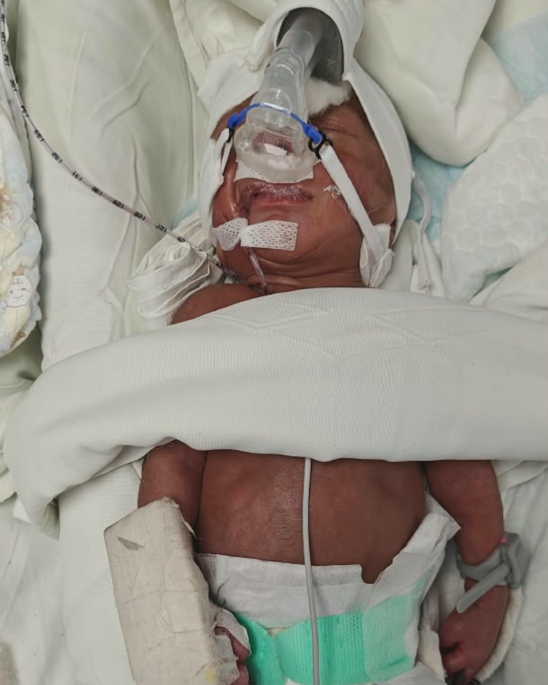 Baby of Sumitra Needs Your Help